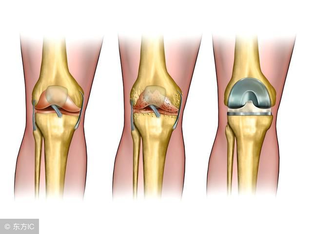 十个膝盖疼,九个滑膜炎,1把黑豆加分心木,15天