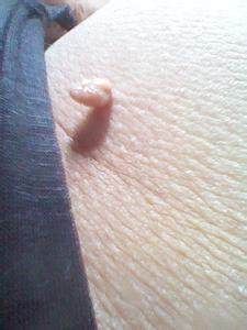 皮肤上脖子上长很多小肉疙瘩?你可要小心了