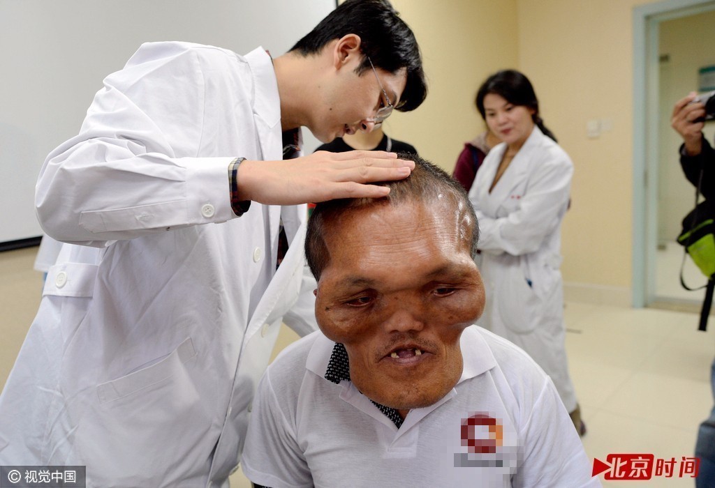 重庆外星人头大如盆 体量超过常人两倍