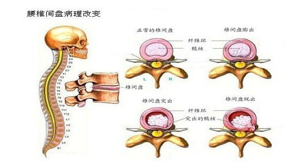 神经等造成刺激和压迫,如出现神经受压,硬膜囊受压,椎