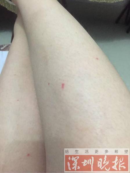 太可怕！女子出差入住酒店遭遇满床活蟲