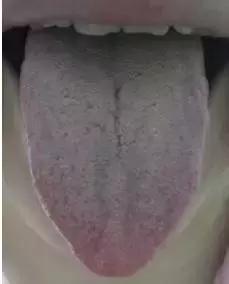 舌苔厚就是有湿?湿气表示这锅我不背