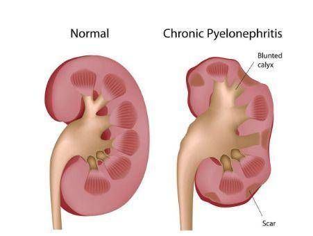 2018世界肾脏病日:得了肾病就不能生孩子吗?