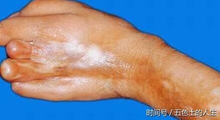 女明星自嘲像得硬皮症人,摊上这种病,不死也