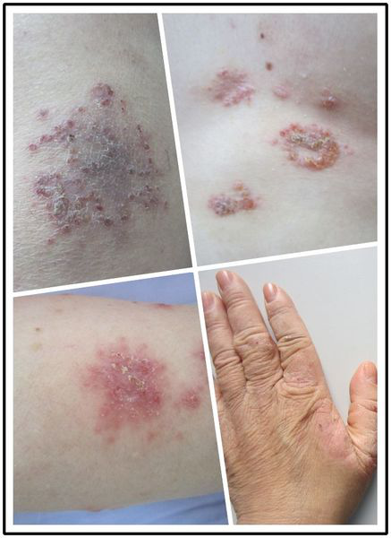 这些微生物主要有金黄色葡萄球菌,马拉色菌,气源性真菌如交链孢霉