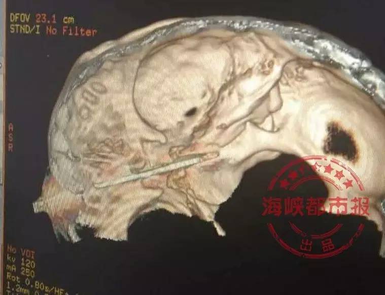 福州男子头插水果刀 淡定排队就诊