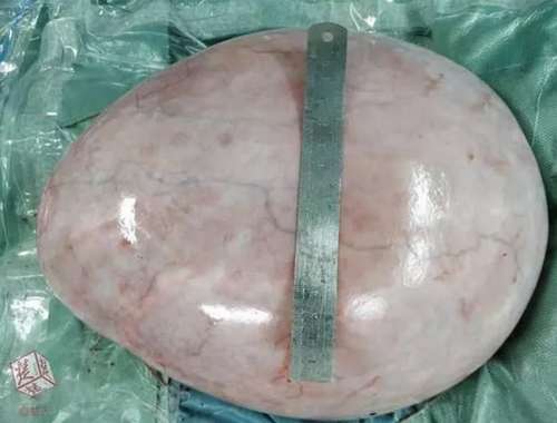 24岁未婚女孩肚子突然变大 原因却说不出口