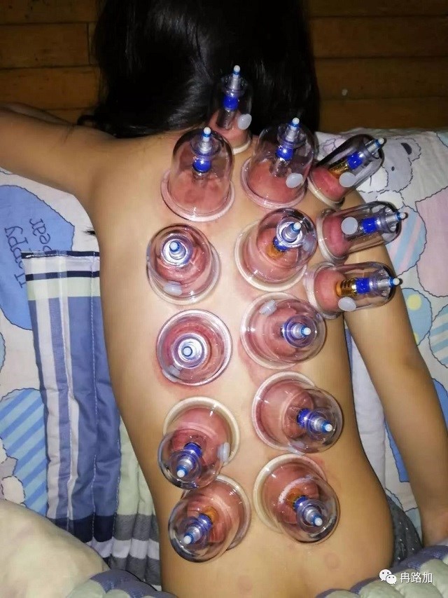 冉路加:5岁孩子流感反复发烧40度,磁罐疗法两