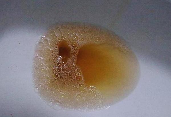 3,小便颜色黄如茶举报   一般来说,我们都知道,尿液是呈淡黄色的庹 