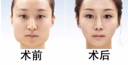 GUGISO磨骨手术对比照片