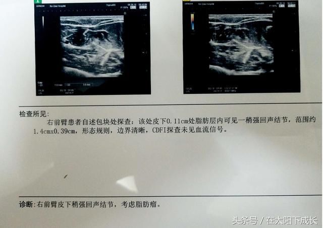 24岁就身上长肉疙瘩,一检查原来是脂肪瘤!