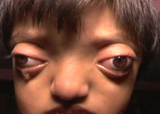 印度女孩患罕见病长"青蛙眼" 饱受痛苦欺凌