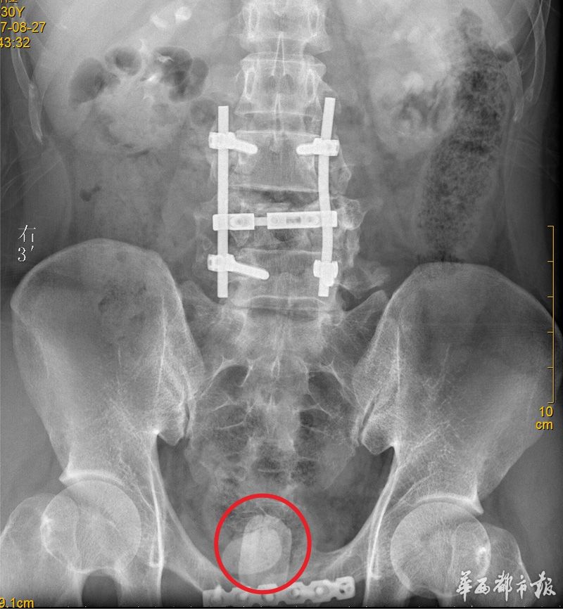 年轻小伙得膀胱结石 竟与10年前车祸有关