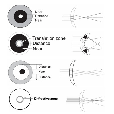 除了OK镜阿托品,其他控制近视的办法有哪些?