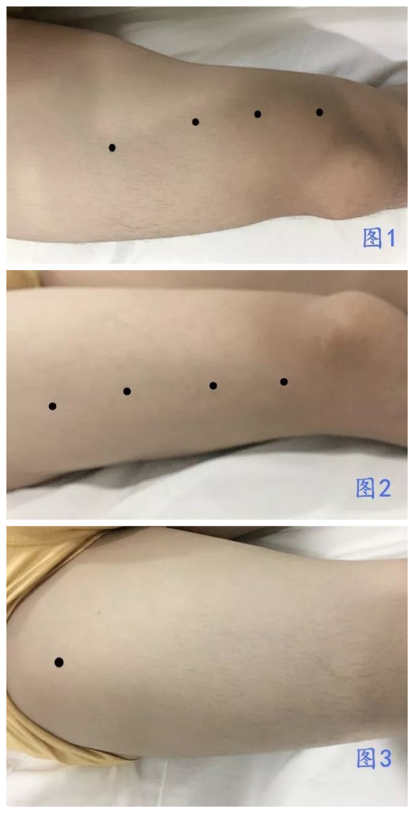 拇指进行深部的触摸,按压(如图1,2,3,左向右依次为:股内侧肌,股外侧肌