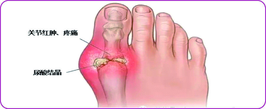 痛风有多疼?有人说疼得就像被狗咬,快试试这两个救人无数的方法