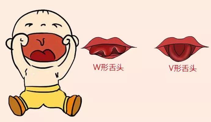 宝宝舌系带过短,剪还是不剪?做手术的最佳年龄