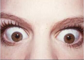 突眼症应该要早早做预防!