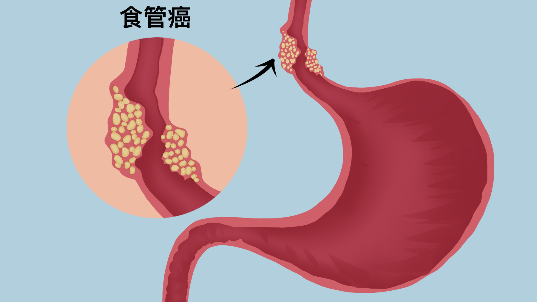 我国学者研发食管癌筛查新方法,助患者早诊早治 我国学者研发食管癌筛查新方法,助患者早诊早治