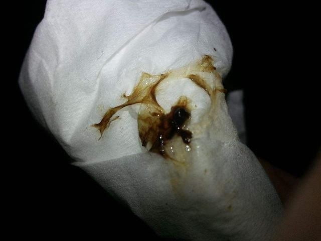 19岁大学生白带异常意外查出宫颈癌,医生:都是