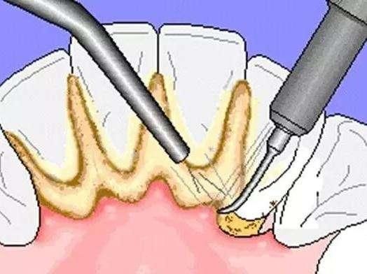 牙齿缝里抠出的黄色物质到底是啥?为什么那么