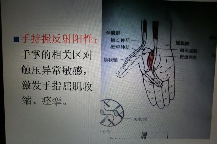 脑瘫反射异常新解及干预1