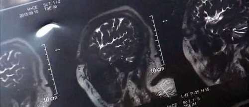 30岁女子头部长大瘤里面布满活虫,医生惊了