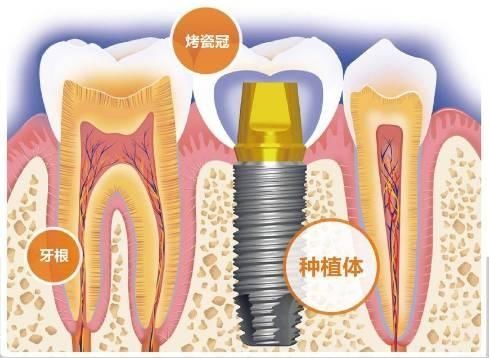 谁适合种牙?种植牙能维持多久?来听听医生讲