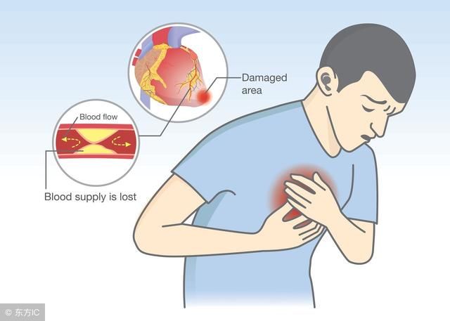 心肌梗死最早最突出的症状