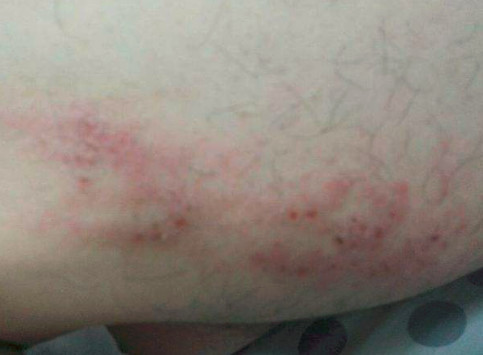 大腿内侧红斑瘙痒怎么办?几点注意事宜一定要