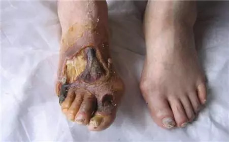 下肢动脉硬化闭塞症三个关键字:疼、麻、凉