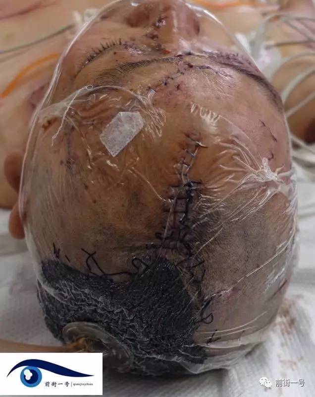 女子给自家宠物狗喂食时被咬伤 头皮被撕掉一半