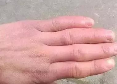 冻疮未破时,可外用复方肝素软膏等.