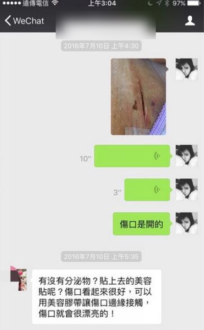 伊能静晒剖腹产伤口照片 反击美医师不认账行为
