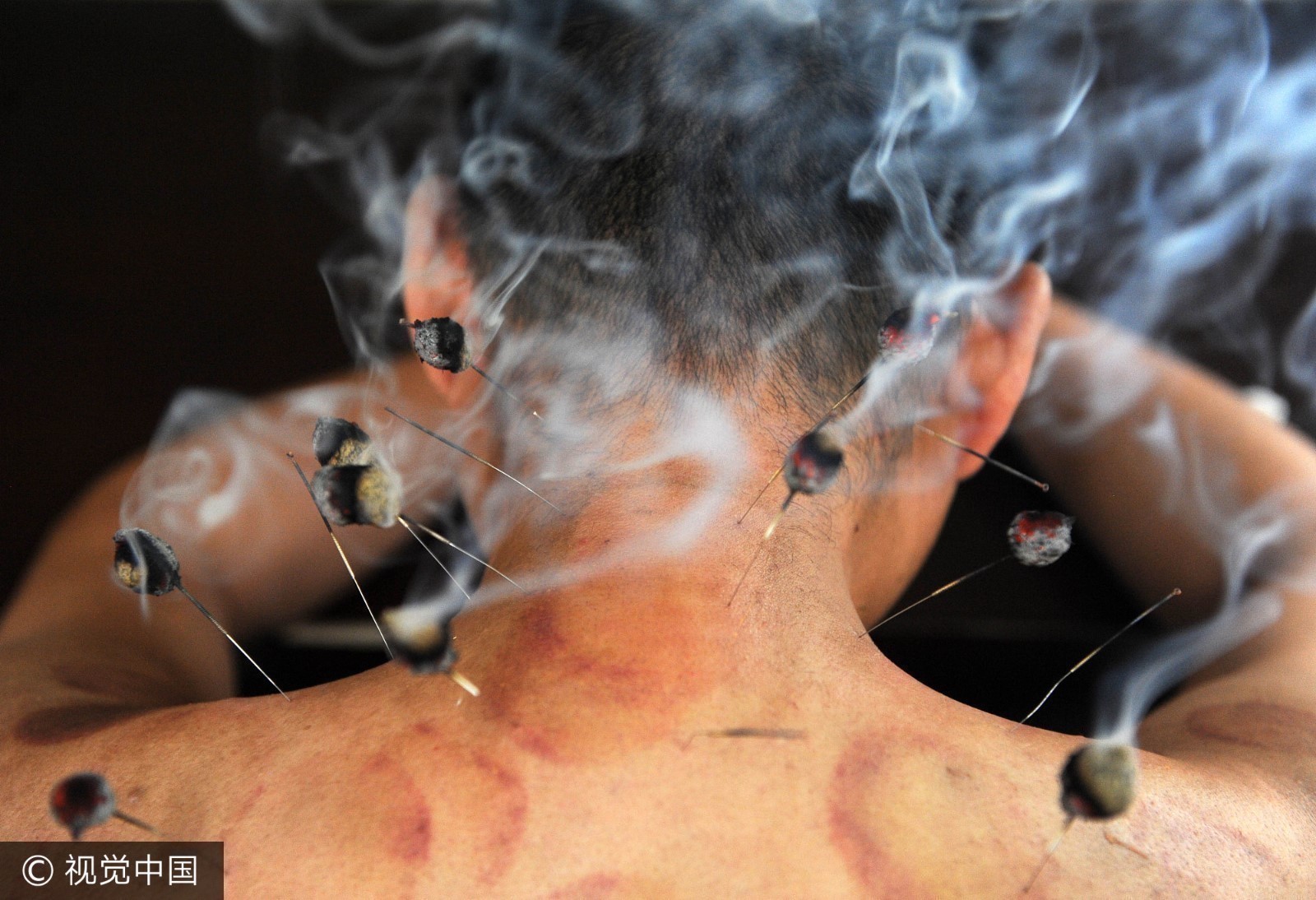 2012年02月21日,陕西咸阳.面瘫患者,面部针灸加电疗辅助治疗.