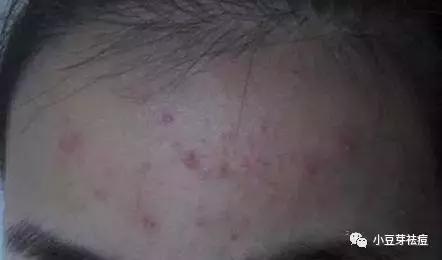 警告!为什么用药了还是治不好痘痘?药店里的祛