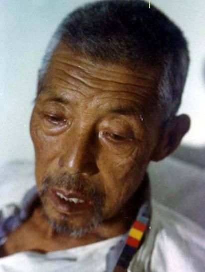 而当肝脏的本色出现在面部时,则说明患者的肝脏病变比较严重.