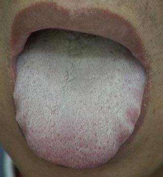 看舌头能知心脑血管疾病,一看一个准