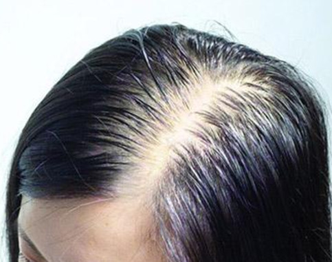 头部脂溢性皮炎怎样治疗?这些方法你一定想不