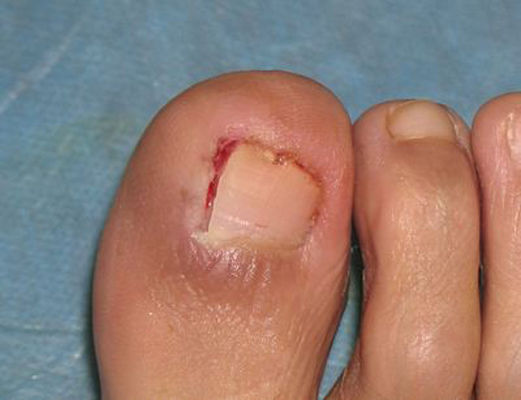 指甲扎进肉18个月,才知道,只需一"笨招",彻底剪除钳甲之痛