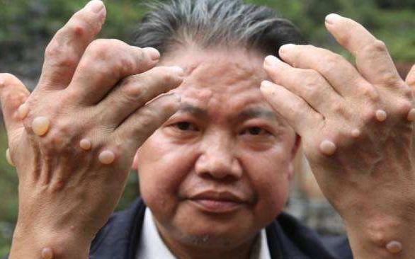 大家都在学降尿酸最好的方法!