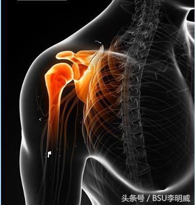 你的肩痛,可能与冈上肌肌腱炎有关!