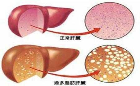 脂肪肝中重度严重吗 轻度脂肪肝保险