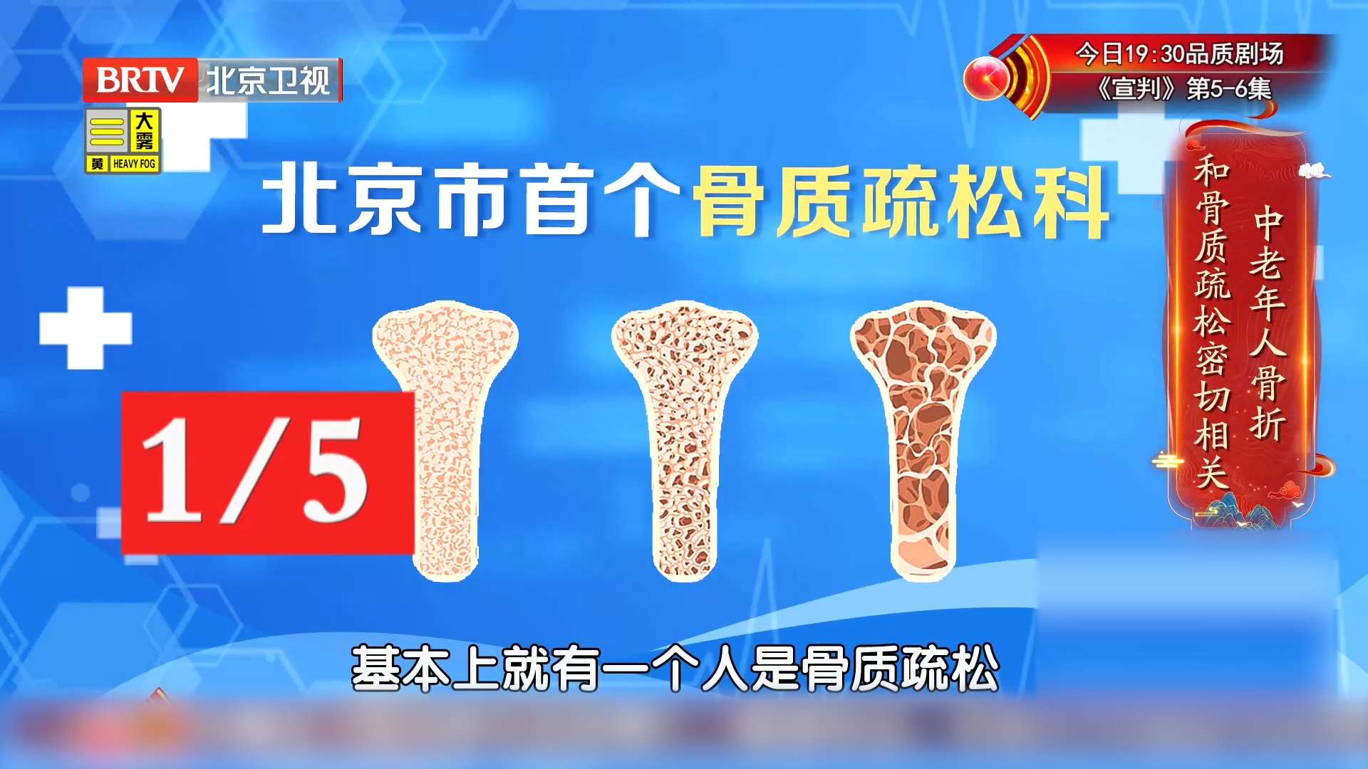 别轻视，我国50岁以上的人群中，每5个就可能有一个是骨质疏松！