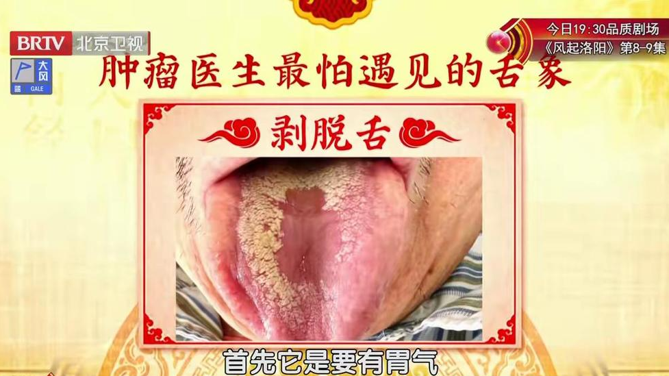 【舌象】观舌辨证识噎膈 【舌象】观舌辨证识噎膈