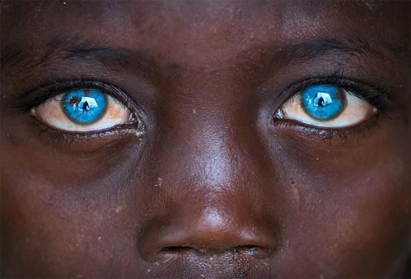 非洲一儿童现蓝色眼睛 令人难以置信