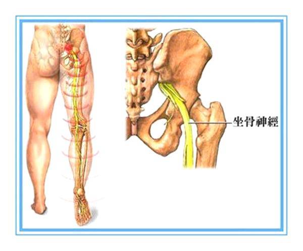 坐骨神经痛反复发作的原因和治疗方法你知道多