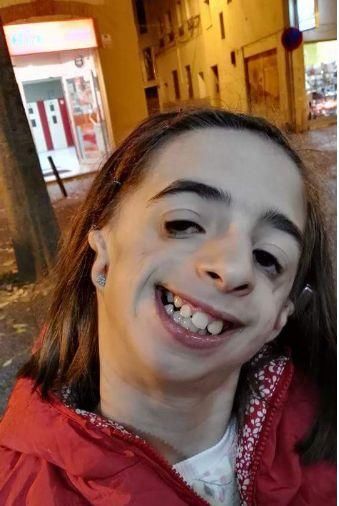 女儿出生面部严重畸形医生建议安乐死,父母不抛弃她要坚持做手术