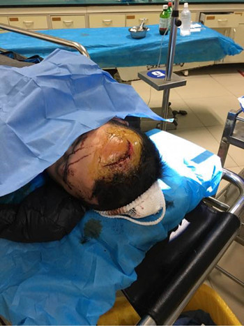 李先生头部被打住院(图片由李先生提供)