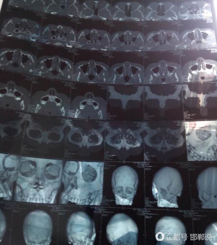 邯郸市三中老师打学生,致使鼻梁骨骨折